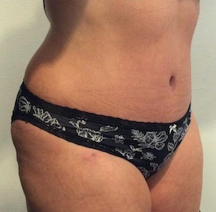 Tummy Tuck Before & After Patient #1541
