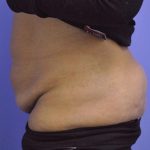 Tummy Tuck Before & After Patient #1541