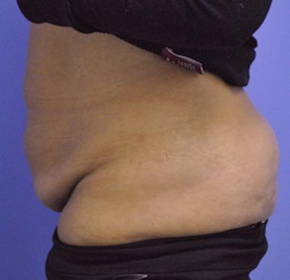 Tummy Tuck Before & After Patient #1541