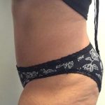 Tummy Tuck Before & After Patient #1541