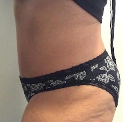 Tummy Tuck Before & After Patient #1541