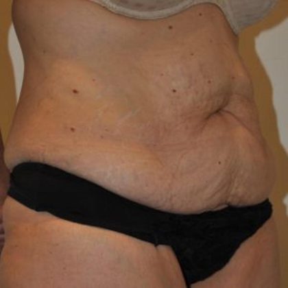 Tummy Tuck Before & After Patient #1542