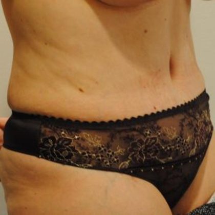 Tummy Tuck Before & After Patient #1542