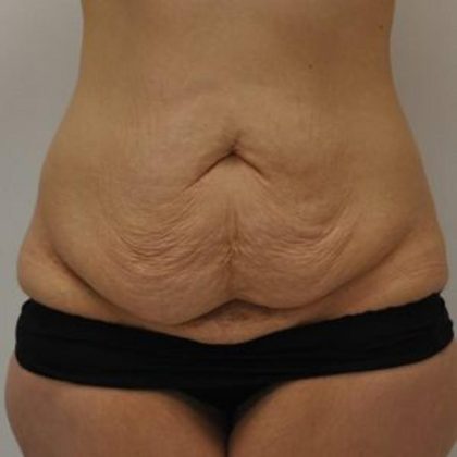 Tummy Tuck Before & After Patient #1543
