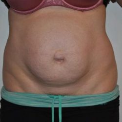Tummy Tuck Before & After Patient #1544