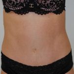 Tummy Tuck Before & After Patient #1544