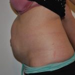 Tummy Tuck Before & After Patient #1544