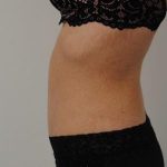 Tummy Tuck Before & After Patient #1544