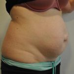 Tummy Tuck Before & After Patient #1544
