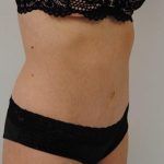 Tummy Tuck Before & After Patient #1544