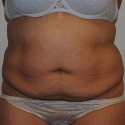 Tummy Tuck Before & After Patient #1545