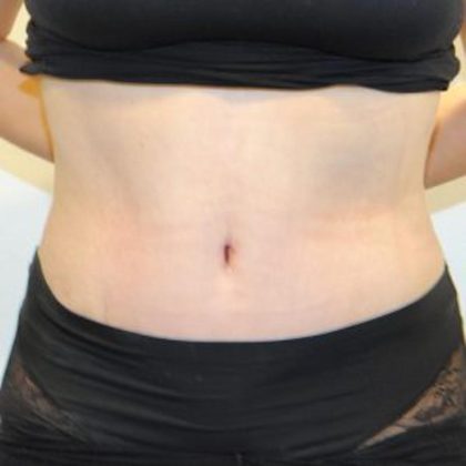 Tummy Tuck Before & After Patient #1545