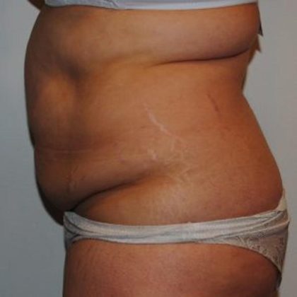 Tummy Tuck Before & After Patient #1545