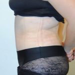 Tummy Tuck Before & After Patient #1545