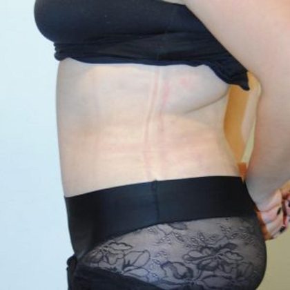 Tummy Tuck Before & After Patient #1545