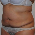 Tummy Tuck Before & After Patient #1545