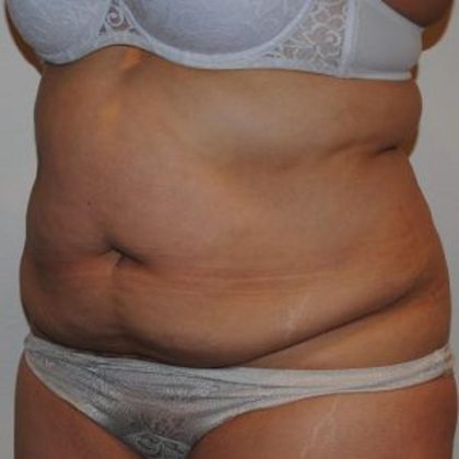 Tummy Tuck Before & After Patient #1545