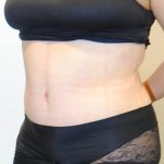Tummy Tuck Before & After Patient #1545