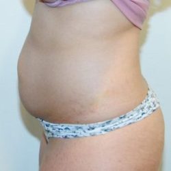 Tummy Tuck Before & After Patient #1532