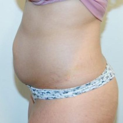 Tummy Tuck Before & After Patient #1532