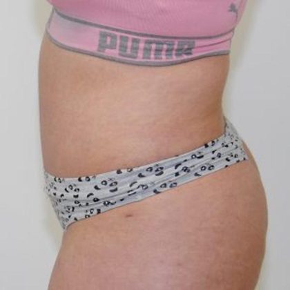 Tummy Tuck Before & After Patient #1532