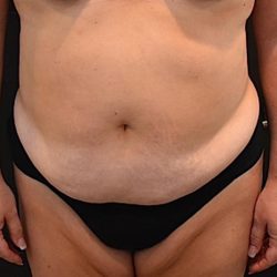 Tummy Tuck Before & After Patient #1533