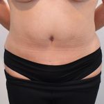 Tummy Tuck Before & After Patient #1533