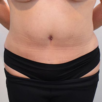 Tummy Tuck Before & After Patient #1533