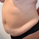 Tummy Tuck Before & After Patient #1533