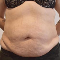 Tummy Tuck Before & After Patient #1535
