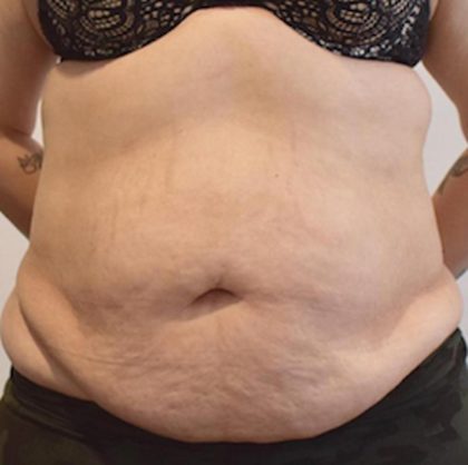 Tummy Tuck Before & After Patient #1535