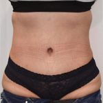Tummy Tuck Before & After Patient #1535