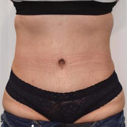 Tummy Tuck Before & After Patient #1535