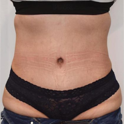 Tummy Tuck Before & After Patient #1535