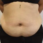Tummy Tuck Before & After Patient #1538
