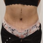 Tummy Tuck Before & After Patient #1538