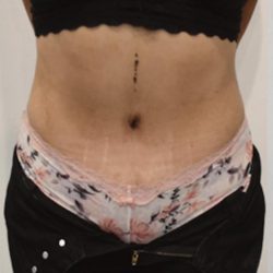Tummy Tuck Before & After Patient #1538