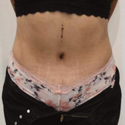 Tummy Tuck Before & After Patient #1538