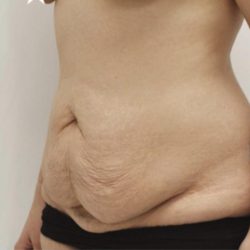Tummy Tuck Before & After Patient #1539