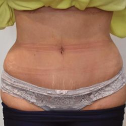 Tummy Tuck Before & After Patient #1540