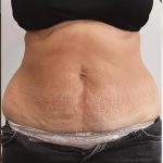 Tummy Tuck Before & After Patient #1540