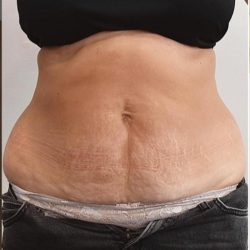 Tummy Tuck Before & After Patient #1540