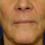 Wrinkles Before & After Patient #1648