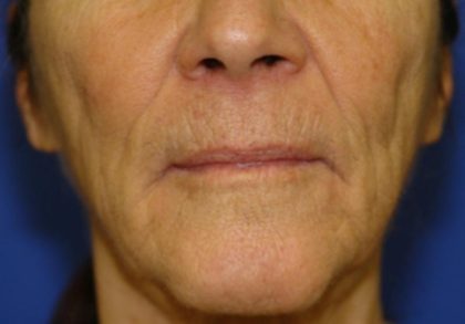 Wrinkles Before & After Patient #1648