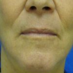 Wrinkles Before & After Patient #1648
