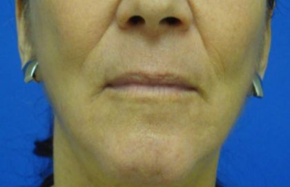 Wrinkles Before & After Patient #1648