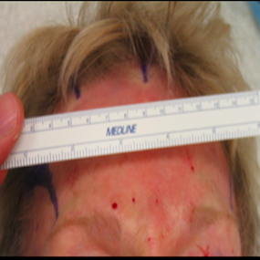 Nerve Decompression Before & After Patient #2644