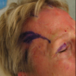 Nerve Decompression Before & After Patient #2644