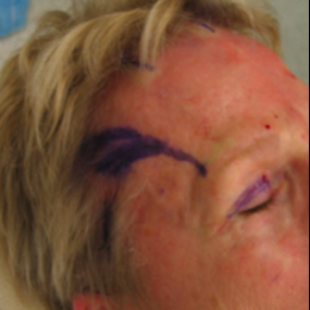 Nerve Decompression Before & After Patient #2644