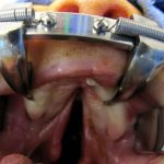 Cleft lip and palate Before & After Patient #2356